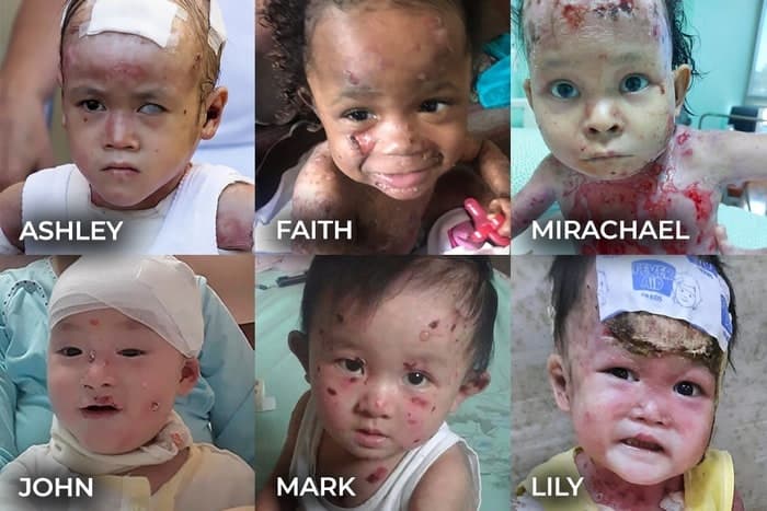 Help babies with EB
